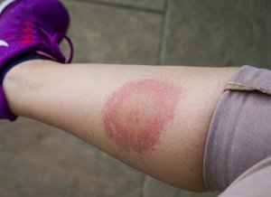 Lyme-Borreliose, alles was du darüber wissen musst