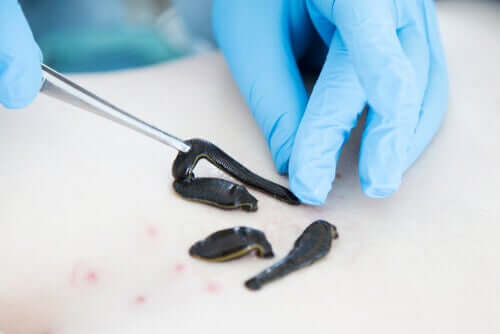 Arzt setzt Blutegel auf der Haut auf