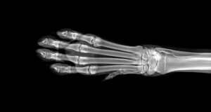 geschwollene Beine - Röntgenbild